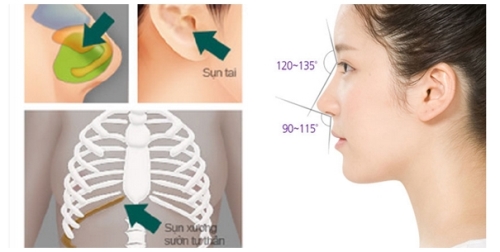 Nâng mũi bằng sụn tự thân có nhiều ưu điểm vượt trội Nâng mũi bằng sụn tự thân có nhiều ưu điểm vượt trội