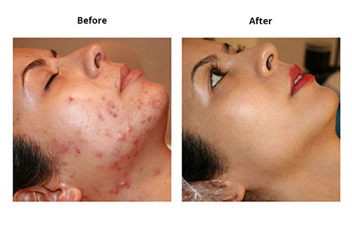 Trị mụn trứng cá rất hiệu quả Trị mụn trứng cá rất hiệu quả